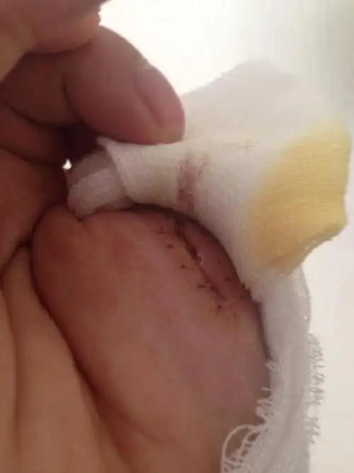 我的伤口是斜着刮坏的.拆线后发现愈合了一半.