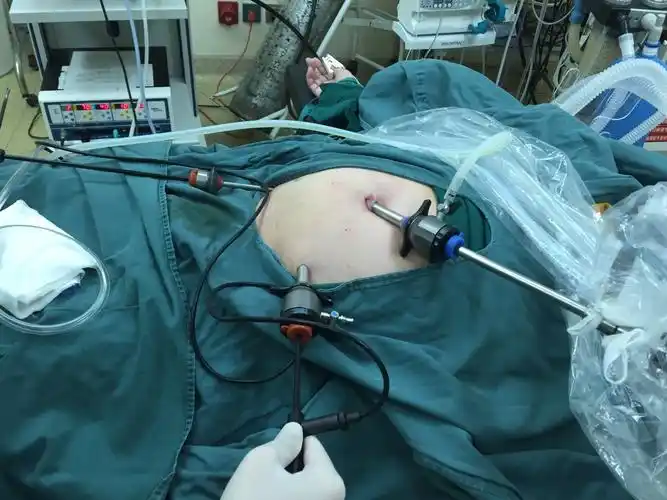 腹腔镜下阑尾切除术 石狮市医院普外科