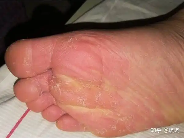 之前一直以为只有男生才会得脚气脚臭,我得了脚气之后才知道女孩子的