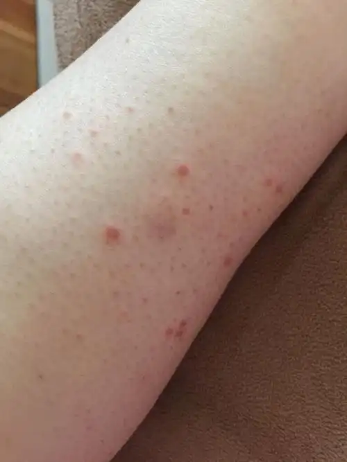 谁能告诉我这些红色痘痘是什么,不痛不痒,怀孕晚期长的,宝宝出生了也