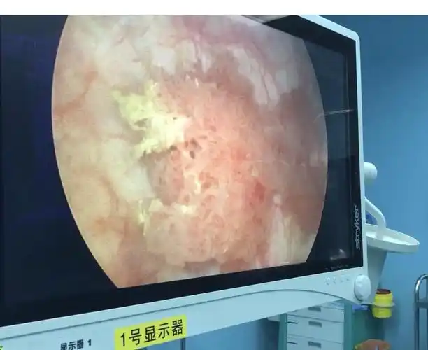 膀胱内的菜花样肿物