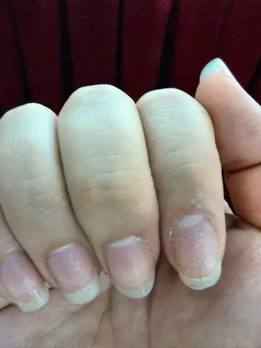 手指甲上有白点,且坑坑洼洼的,是什么问题?