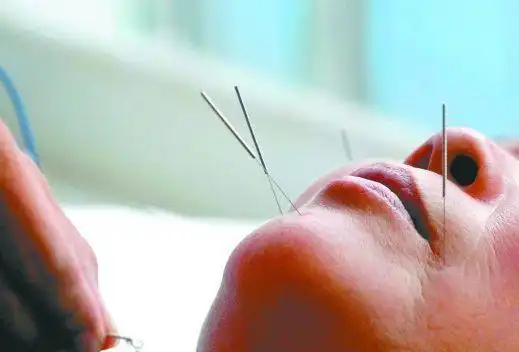 彭静山针刺面瘫十法