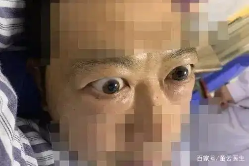 女子查出甲亢半年后,眼睛瞪得像铜铃!预防甲亢突眼注意这8点