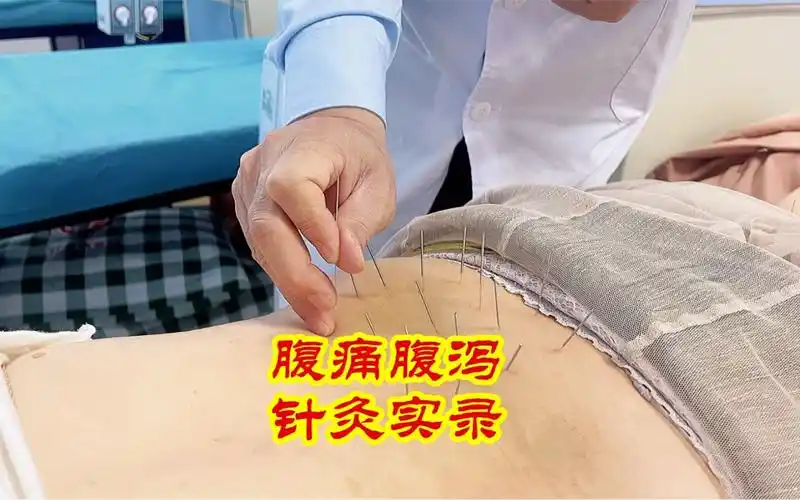 腹痛腹胀腹泻 针灸实录_哔哩哔哩_bilibili