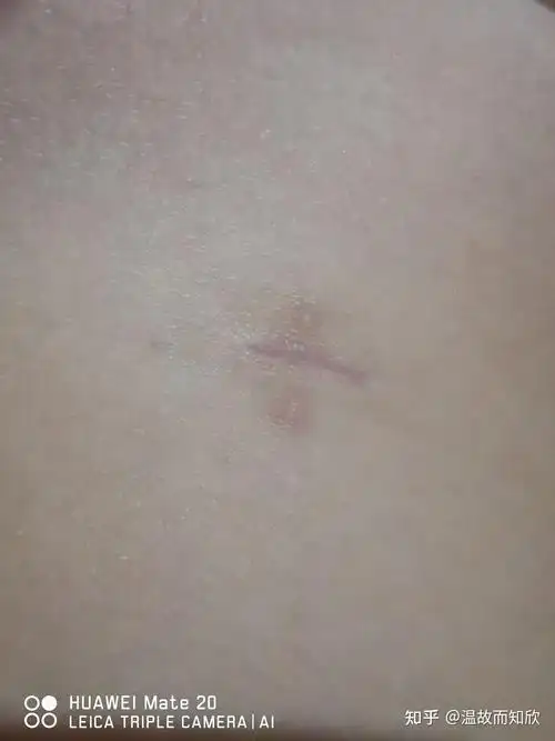 记慢性阑尾炎手术--(腹腔镜)