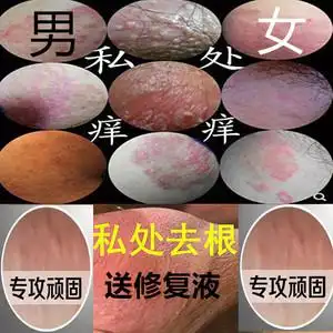 阴囊瘙痒潮湿私处蛋蛋睾丸痒大腿内侧瘙痒止痒膏男女皮肤霜湿疹