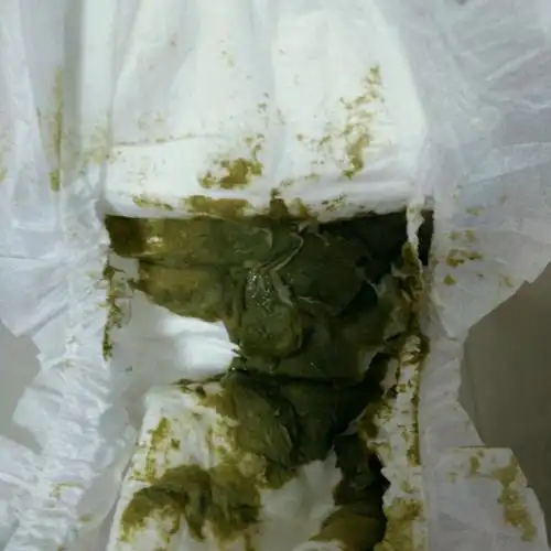 专家解答"婴儿大便呈绿色的原因"