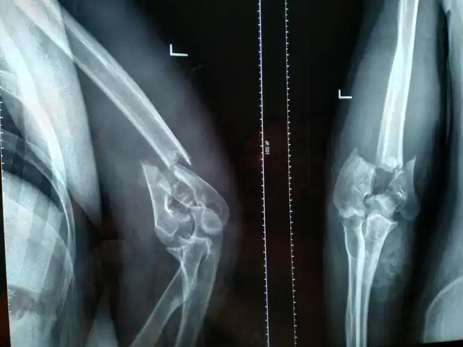 肱骨髁上髁间粉碎性骨折