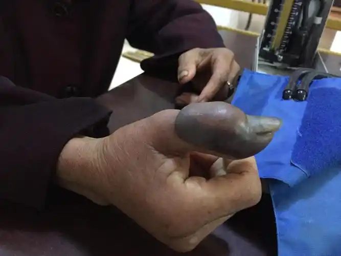 手指拇指坏疽伴感染