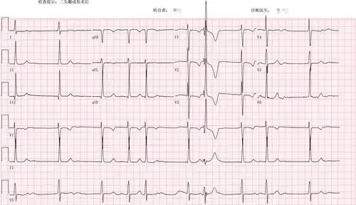 心电图检查>>>>61岁,女性,二尖瓣成形术后9月,洋地黄停用3月.
