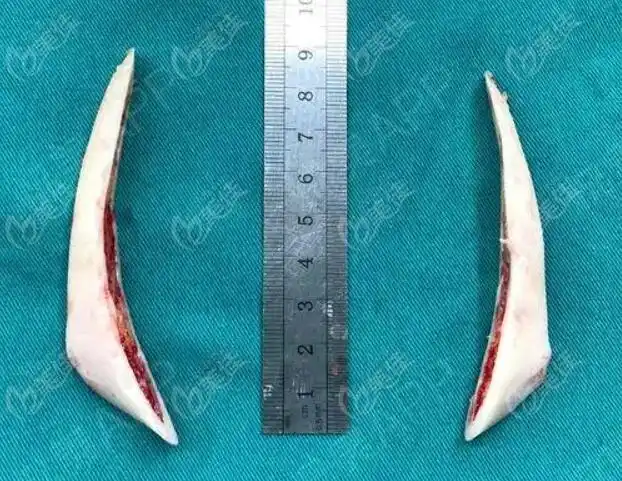 国内十大下颌角手术名医展示说的是国内做下颌角有名的医生