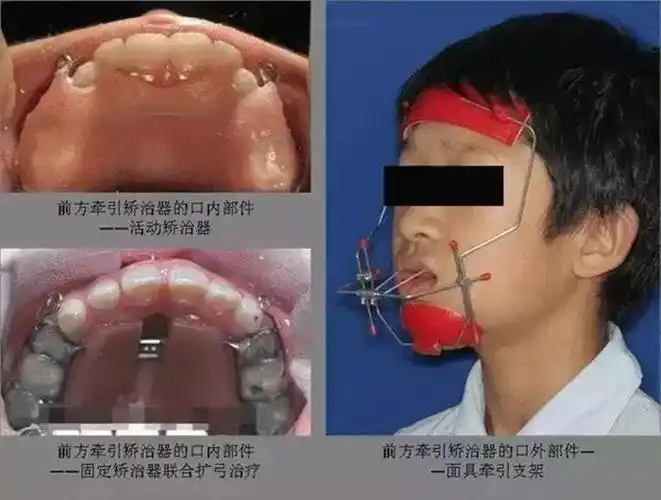 小孩地包天牵引器