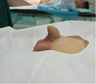 垢,尿道口,包皮处囊肿,包皮粘连等情况,在检查阴茎之外同时也检查睾丸