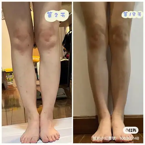 矫正腿型18天