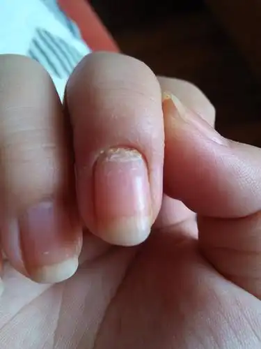 手指甲为什么这个样子?19岁女.