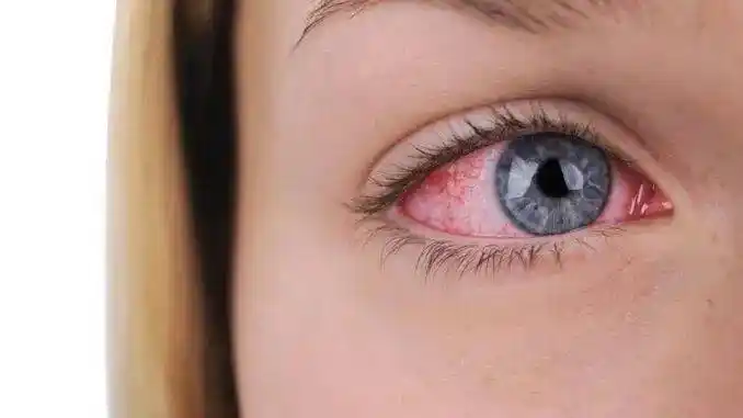 干眼症所致眼炎除上述以外,应正确认识疾病,树立长期管理模式干燥