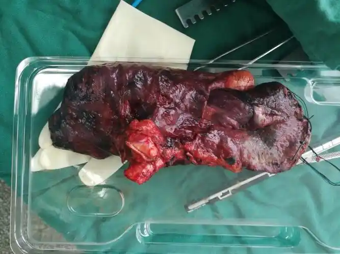 医院 外四科近日完成一例心包内结扎左上肺静脉行左全肺切除…(副本)