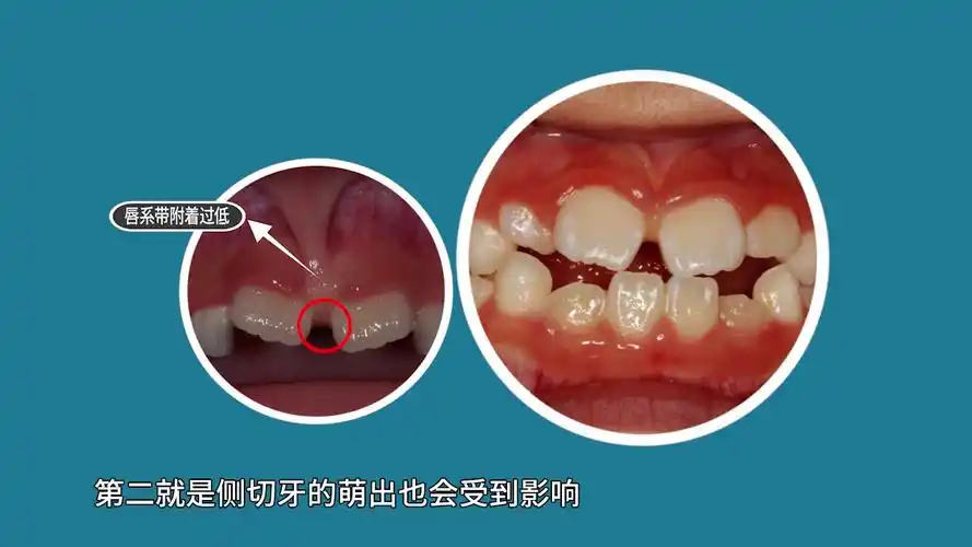 孩子的门牙呈外八字形萌出正常吗?