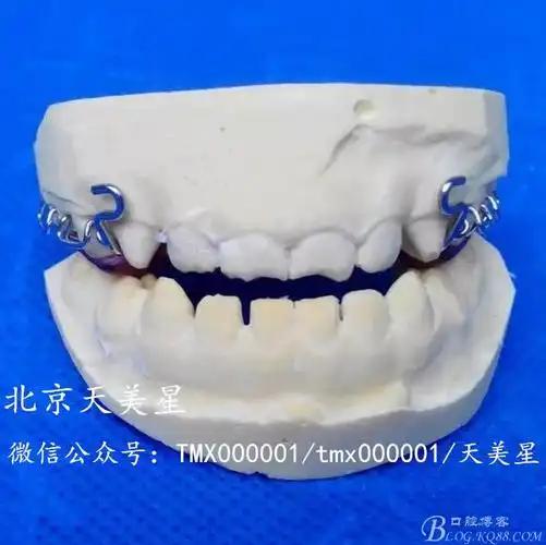 调磨颌垫,使前牙打开2～3m m,调整活动矫正器的固位力,试戴前方牵引器