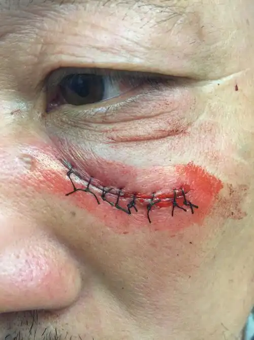 眼睛下方 (面部)被打裂开缝8针4厘米 请问构成什么伤?