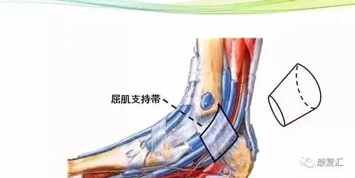 足底疼痛酸胀怎么办?超全踝管综合征治疗方案
