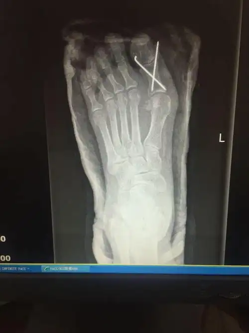 趾骨骨折经典案例-病例讨论-唯医,allinmd