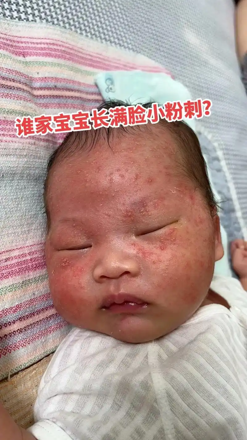 谁家宝宝长满脸的小粉刺?