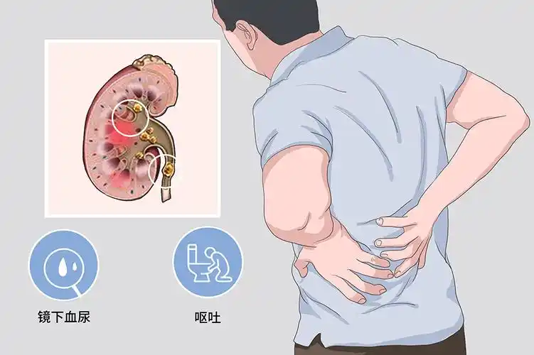 肾绞痛