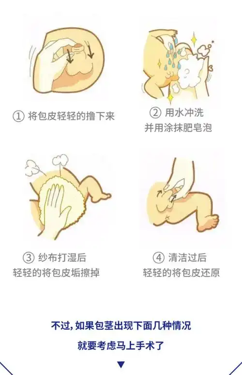 暑假都在扎堆割包皮,家有男宝到底割还是不割?