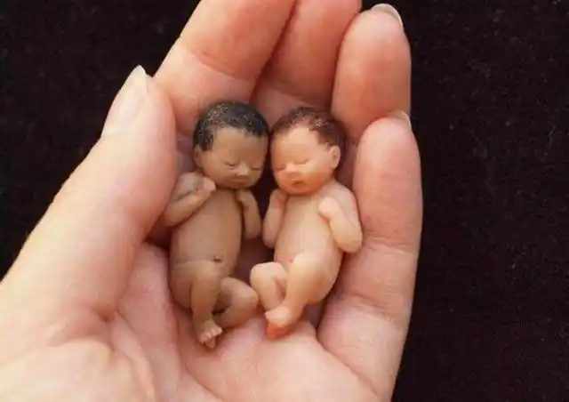 是我生的吗?新生儿太"丑"遭亲妈嫌弃,医生:这很正常