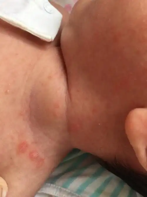 宝宝脖子里发的小红斑是什么?