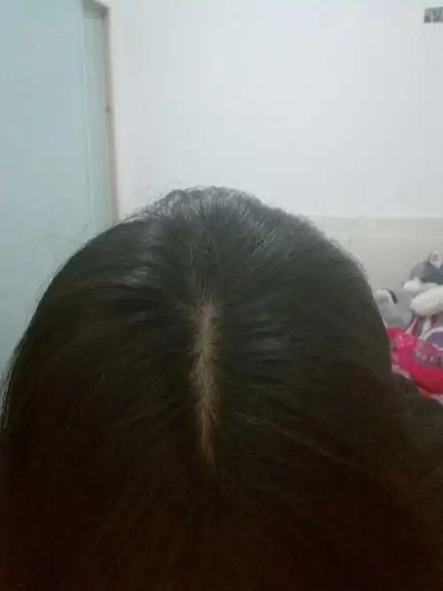 女生头顶头发少是什么体验 ?