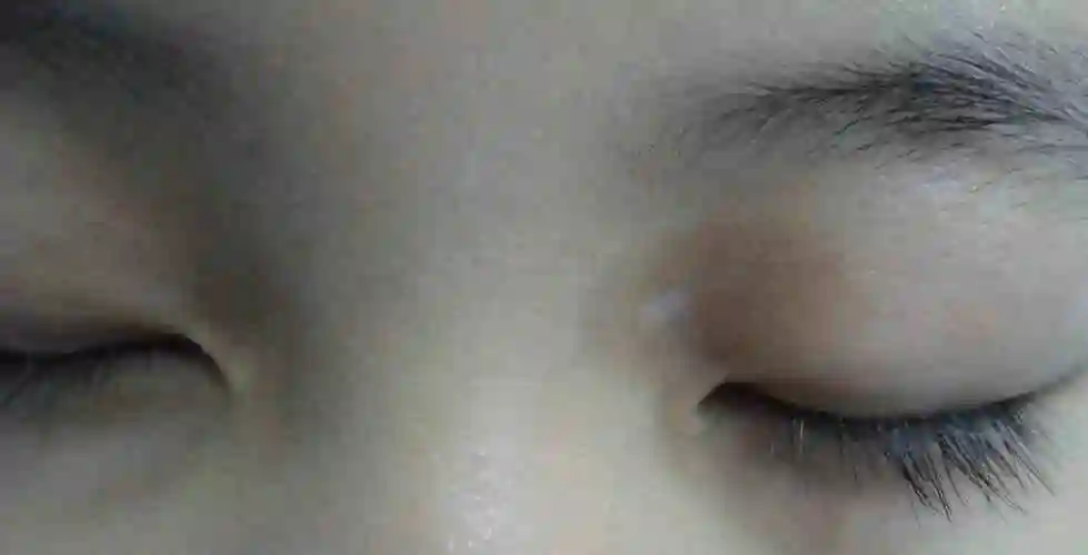 眼睑白斑wood灯检查: 皮损颜色呈白色眼睑部白癜风2月余