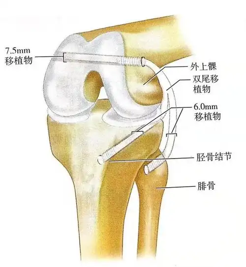 网易首页>网易号>正文申请入驻> ▲ 示意图股骨隧道沿髁轴方向,由外侧