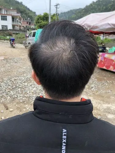 短短一星期时间掉发特严重,男士,头发掉了好多,为啥啊?