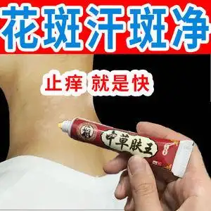 去汗斑花斑癣去汗斑癣治汗斑花斑药膏廯块特效去汗班花班汗斑癣膏