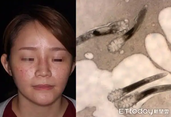 女子脸部长红疹及脓疱又刺又痒,医师发现她脸上的「蠕形蟎虫」比