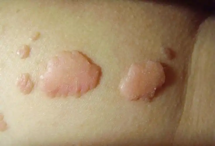 假尖锐湿疣状撞馐酝计琠有来医生