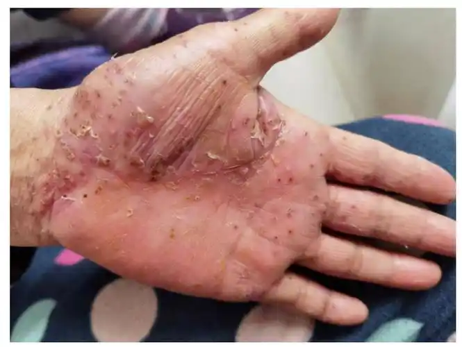 深圳问止中医门诊部:丘述兴治愈打疫苗后出现的汗疱