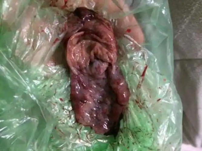 早孕药流排出的孕囊形状图片