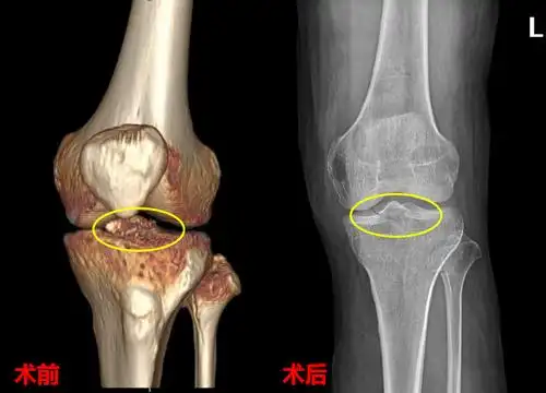 疼痛,肿胀,活动受限,在外院做膝关节x线检查发现是左侧胫骨髁间棘骨折