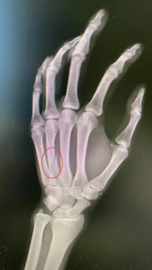 一写作业鸡飞狗跳爸爸一拳挥过去啪一声骨折了