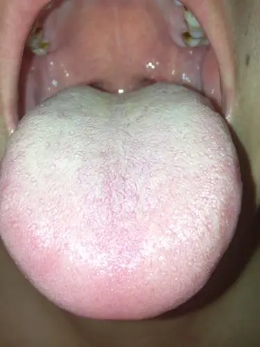 这是舌苔白斑吗?