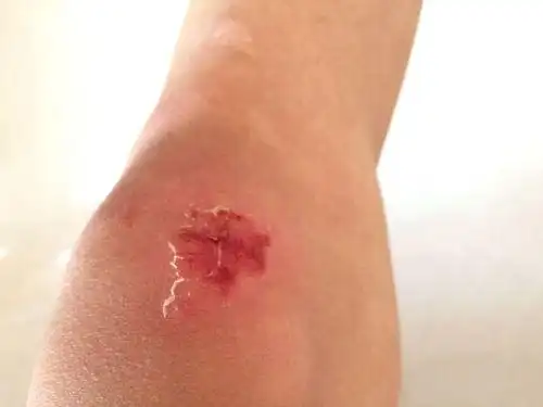 破皮女生膝盖擦破皮图片女生膝盖流血真实图片蹭破皮膝盖擦破皮图片