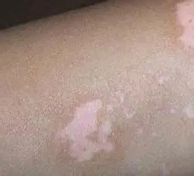 老年性白斑患者要注意科学饮食