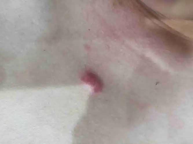 胸前长了个疙瘩好几年了,跟痘痘似的,有谁知道是怎么回事吗?