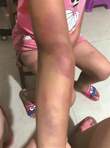 女生被老师暴打的信息在网络上流传,信息配发了数张女童遍体鳞伤的