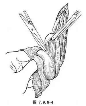 切除附睾  整个附睾自睾丸上游离出来之后,于高位切断输精管,附睾即被