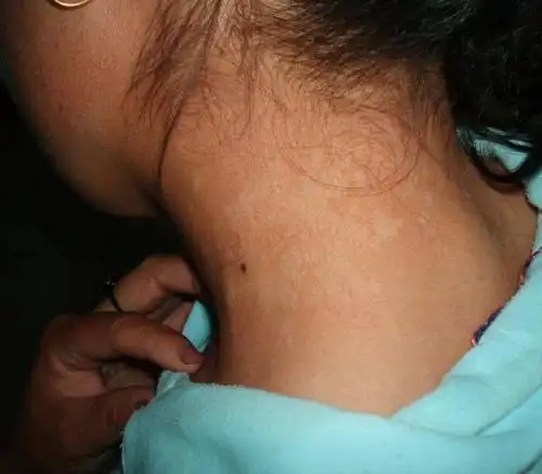 北京花斑癣医院_北京治疗花斑癣哪家医院好_北京治疗花斑癣权威的医院